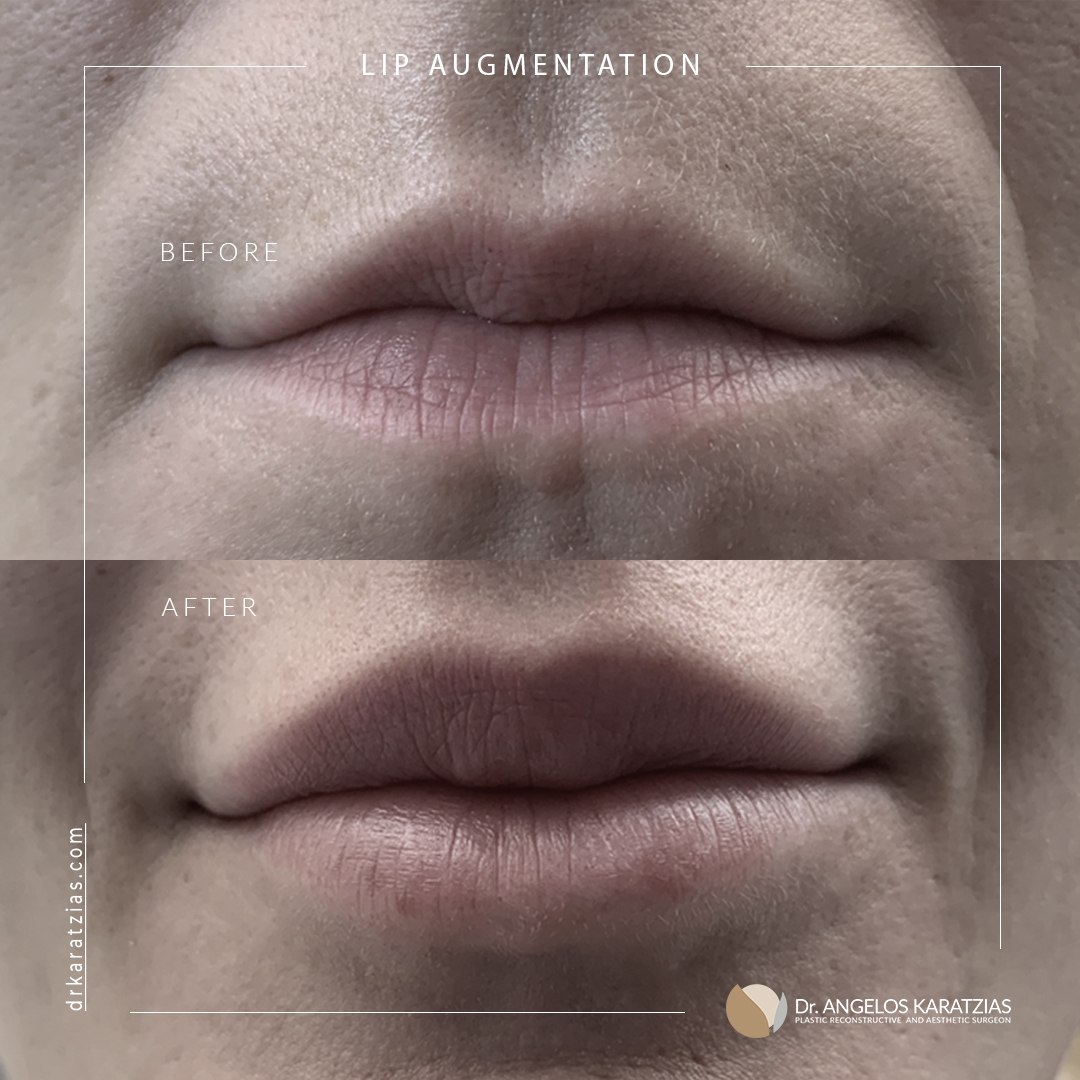 Lip Lift, Face Procedures