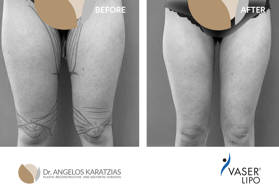 Vaser 3D Lipo | Minimally Invasive Liposuction | Dr Angelos Karatzias