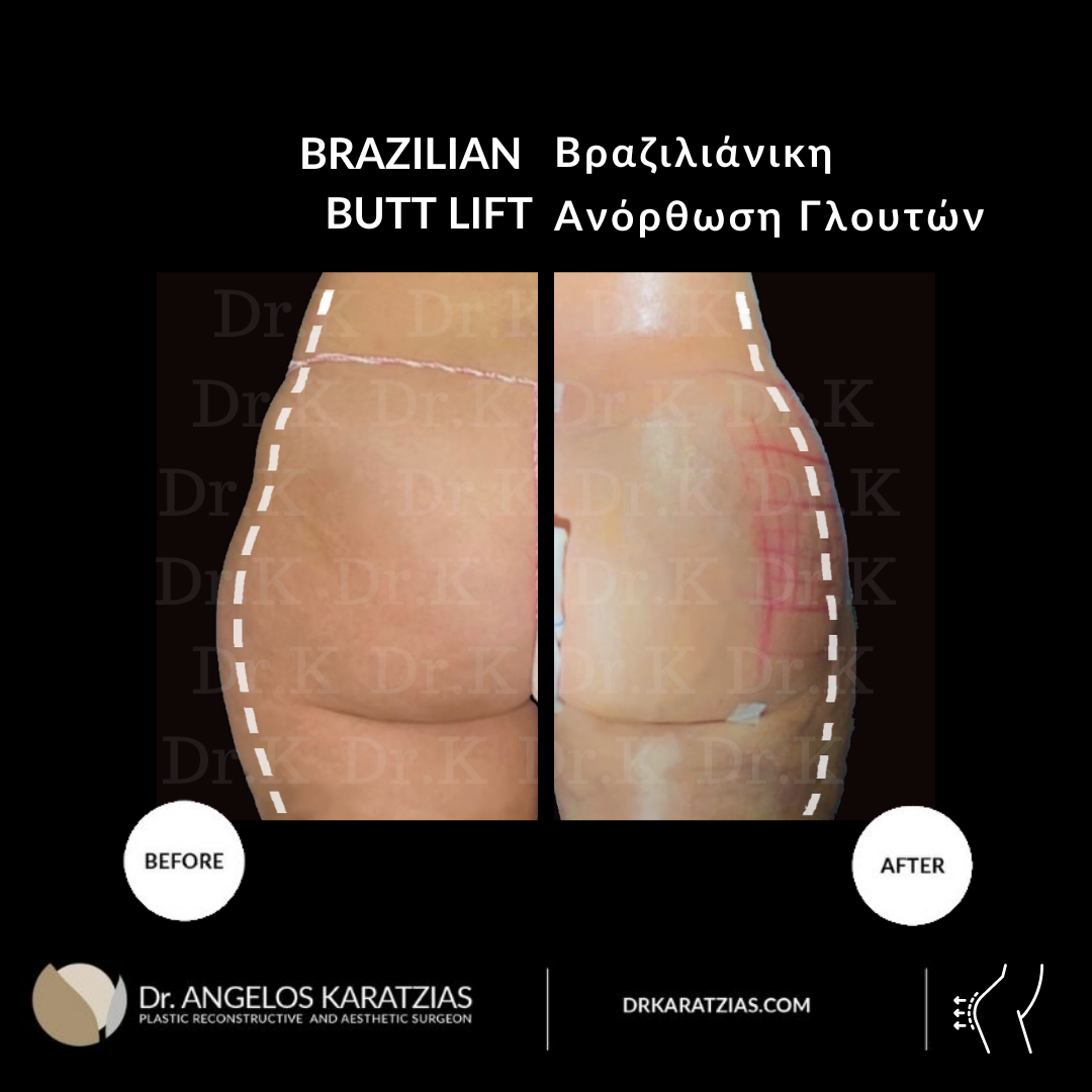 Buttocks Augmentation, Body, Plastic Surgeon