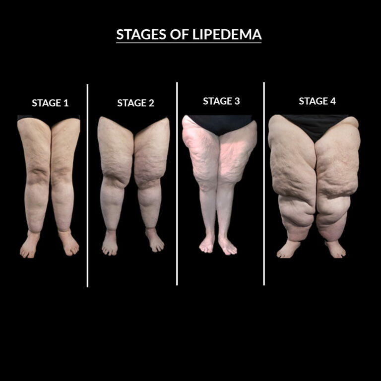 lipedema treatments buttocks ankles