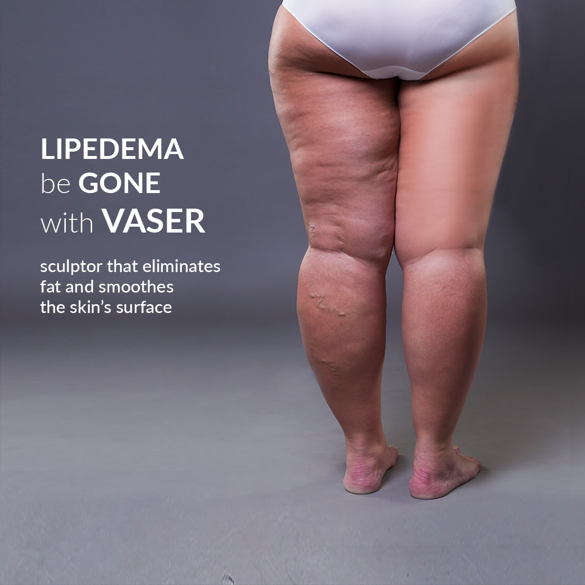 Lipedema: symmetrical bilateral increase of adipose tissue that