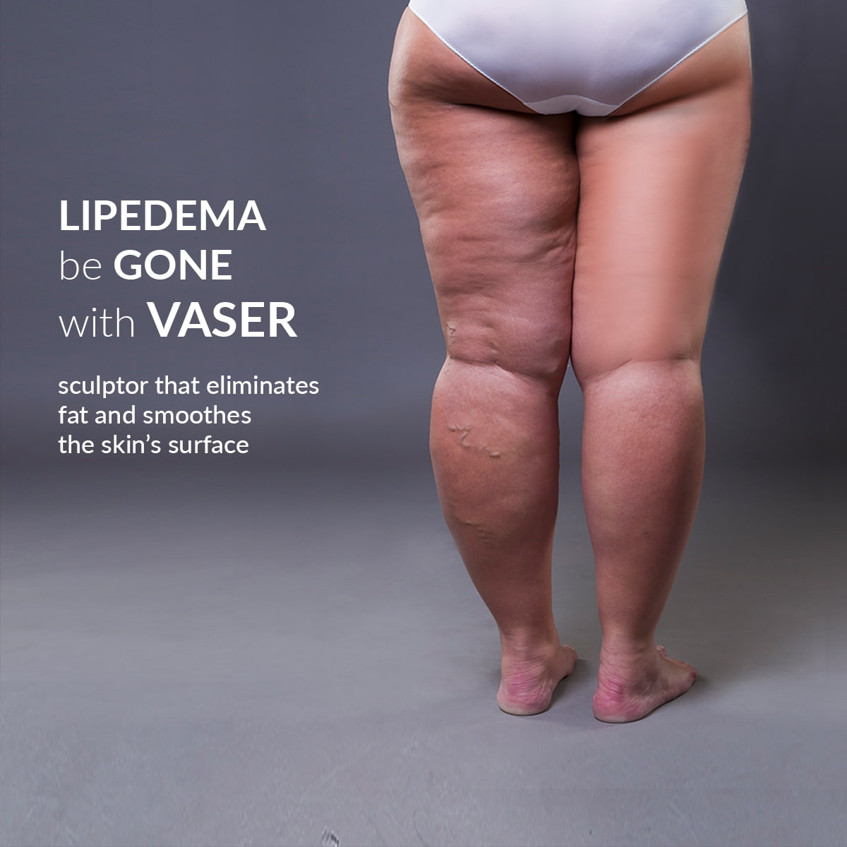 How Lipedema Affects the Lower Legs