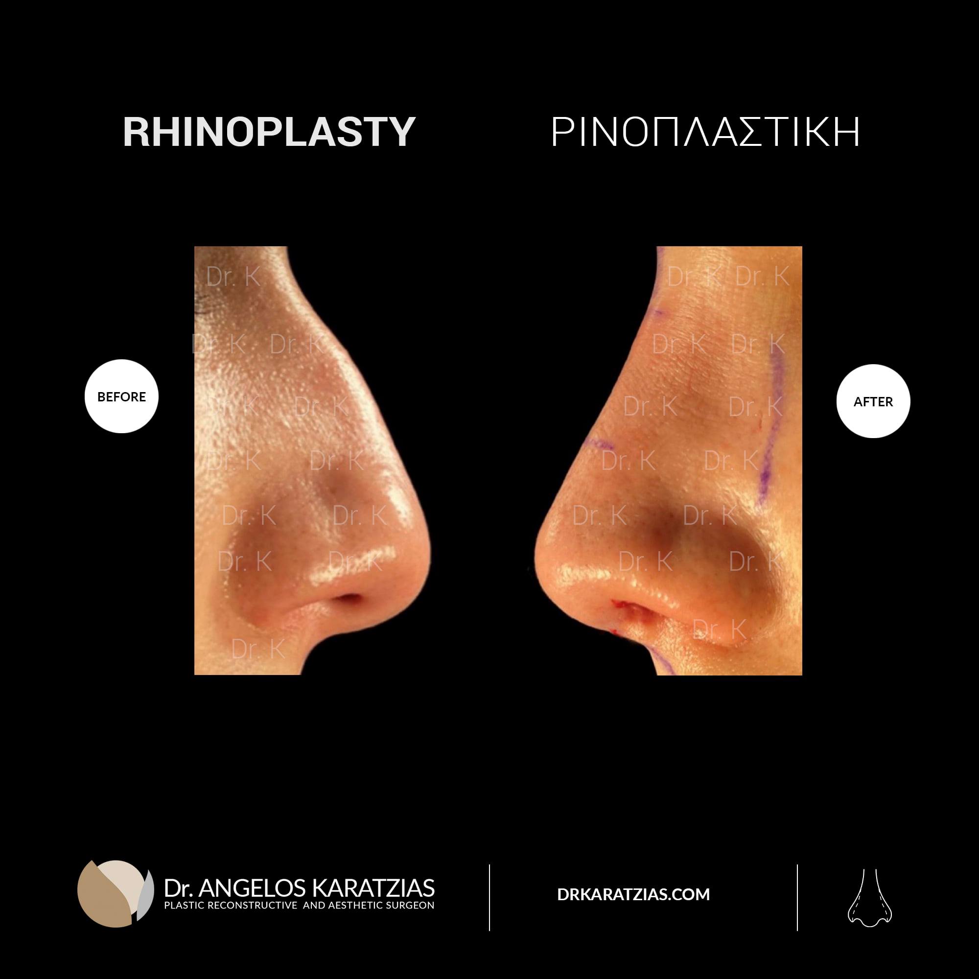 Rhinoplasty Plastic Surgery, Dr Karatzias Surgeon